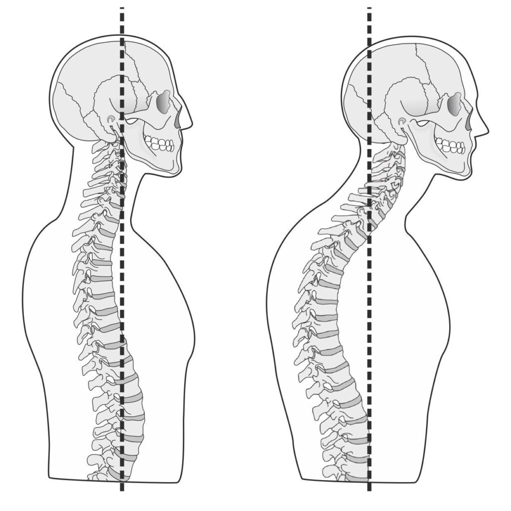 HEAD FORWARD skeleton